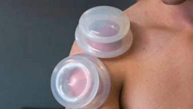 Image for Cupping